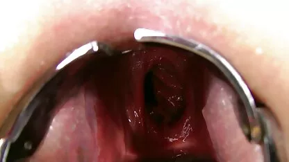Kinkynikky prolapse xo speculum anal cerita sex tante sedarah